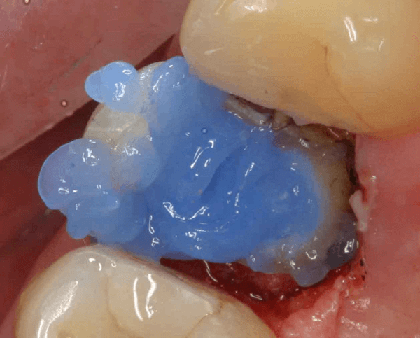 Pulpdent Etch-Rite 38% Phosphoric Acid Etching Gel ET-24