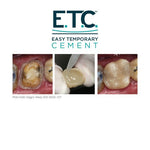 E.T.C. Easy Temporary Cement (1mL-Syringe) S255