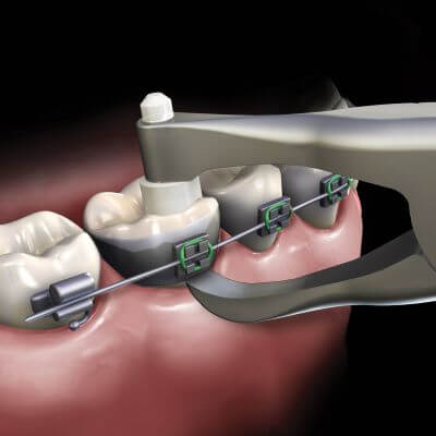 Hu-Friedy Slim Posterior Band Removing Pliers | SurgiMac Dental Supply