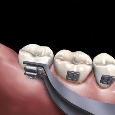 Hu-Friedy Slim Buccal Tube Bonder Tweezers | SurgiMac Dental Supply