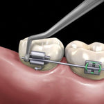 Hu-Friedy Distal Cinch Back Hand Instrument | SurgiMac Dental Supply