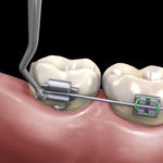 Hu-Friedy Distal Cinch Back Hand Instrument | SurgiMac Dental Supply