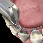 Hu-Friedy Lingual Pin and Ligature Cutter | SurgiMac Dental Supply
