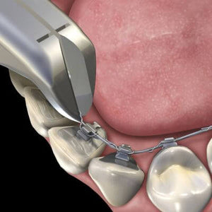 Hu-Friedy Lingual Pin and Ligature Cutter | SurgiMac Dental Supply