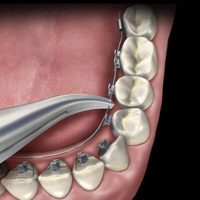 Hu-Friedy Lingual Weingart Pliers | SurgiMac Dental Supply