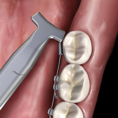 Hu-Friedy Lingual Hammerhead™ NiTi Pliers | SurgiMac Dental Supply