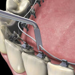 Hu-Friedy Lingual Ligature Director | SurgiMac Dental Supply