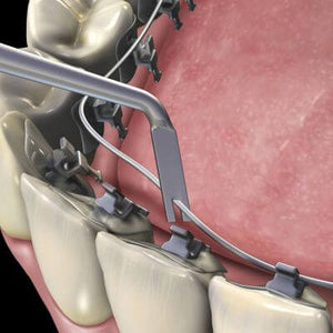 Hu-Friedy Lingual Ligature Director | SurgiMac Dental Supply