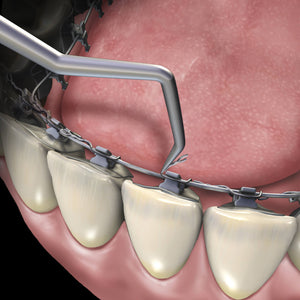 Hu-Friedy Lingual Ligature Director | SurgiMac Dental Supply