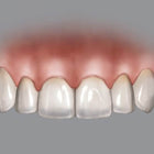 Hu-Friedy BLPG Replacement Tips (3 Tips) | SurgiMac Dental Supply