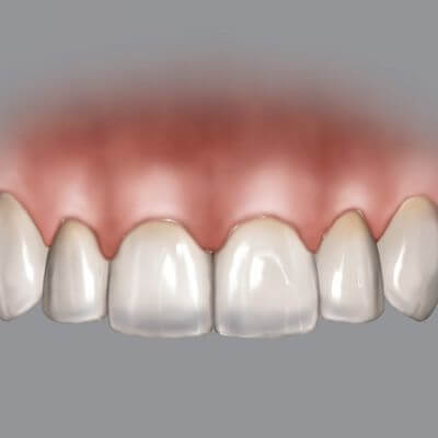 Hu-Friedy BLPG Replacement Tips (3 Tips) | SurgiMac Dental Supply