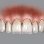 Hu-Friedy BLPG Replacement Tips (3 Tips) | SurgiMac Dental Supply