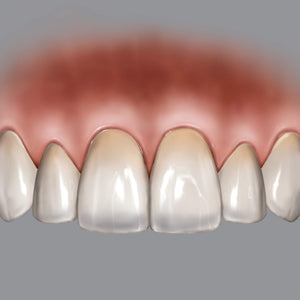 Hu-Friedy BLPG Replacement Tips (3 Tips) | SurgiMac Dental Supply