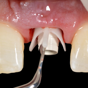 Hu-Friedy Chu Prosthetic Placement Instrument | SurgiMac Dental Supply
