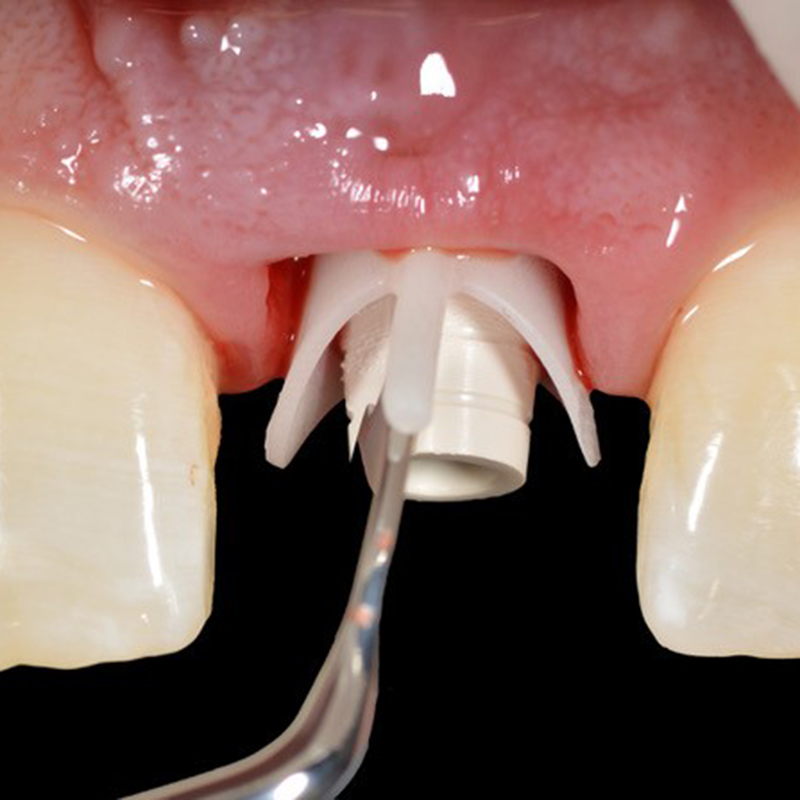 Hu-Friedy Chu Prosthetic Placement Instrument | SurgiMac Dental Supply