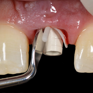 Hu-Friedy Chu Prosthetic Placement Instrument | SurgiMac Dental Supply