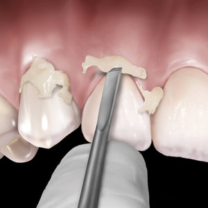 Hu-Friedy 12 Novatech™ Cement Remover | SurgiMac Dental Supply