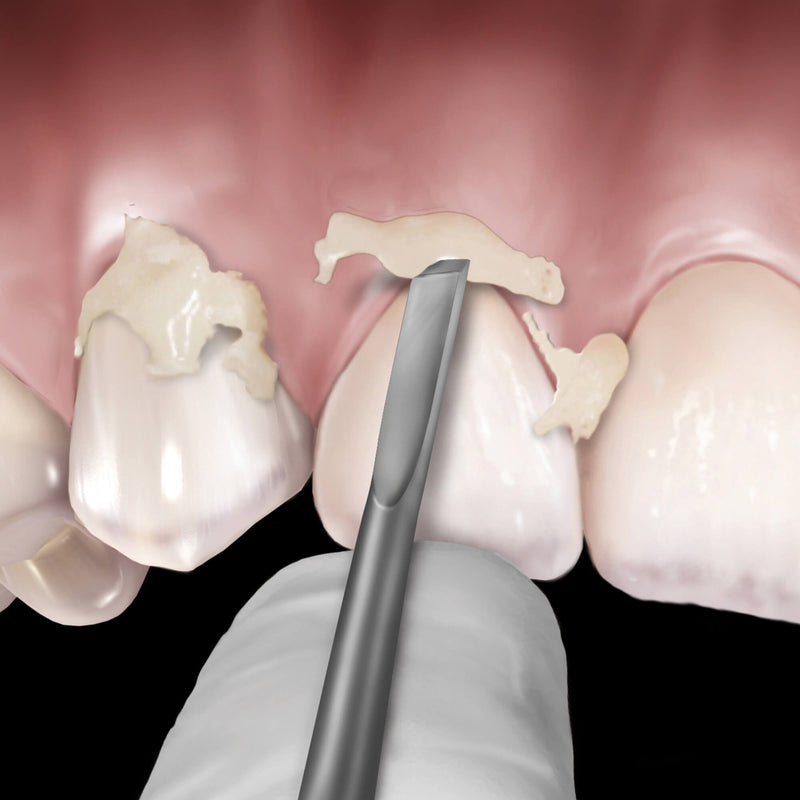 Hu-Friedy 12 Novatech™ Cement Remover | SurgiMac Dental Supply