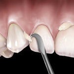 Hu-Friedy 12 Novatech™ Cement Remover | SurgiMac Dental Supply