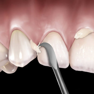 Hu-Friedy 12 Novatech™ Cement Remover | SurgiMac Dental Supply