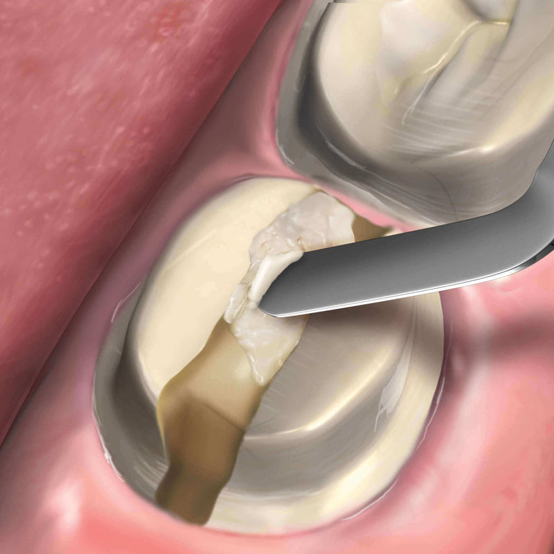 Hu-Friedy 7 Novatech™ Spatula and Blade | SurgiMac Dental Supply