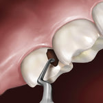 Hu-Friedy Goldstein Interproximal Excavator | SurgiMac Dental Supply