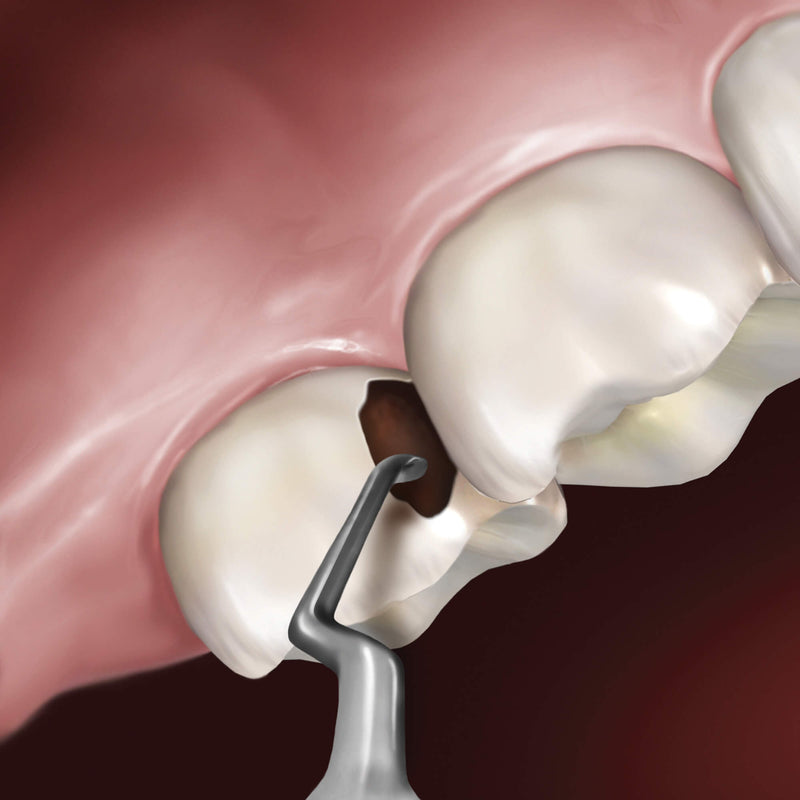 Hu-Friedy Goldstein Interproximal Excavator | SurgiMac Dental Supply