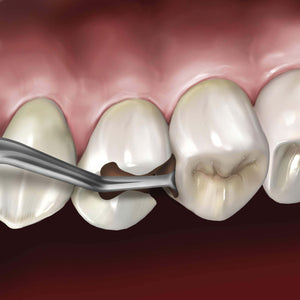 Hu-Friedy Goldstein Interproximal Excavator | SurgiMac Dental Supply