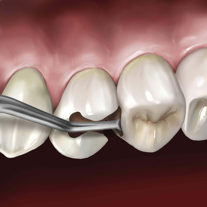 Hu-Friedy Goldstein Interproximal Excavator | SurgiMac Dental Supply