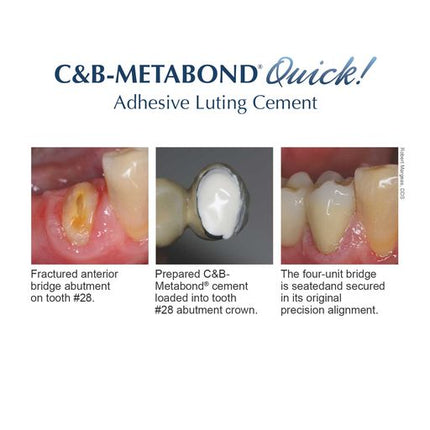C&B Metabond Quick Adhesive Cement System | S380 | | Cement, Cements, Dental, Dental Supplies, liners & adhesives | Parkell | SurgiMac
