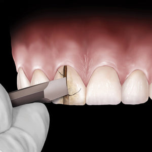 Hu-Friedy Straight Goldstein Crown Remover | SurgiMac Dental Supply