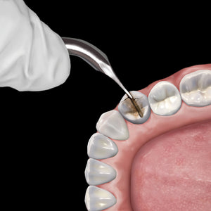 Hu-Friedy Goldstein Crown Remover, 45° | SurgiMac Dental Supply