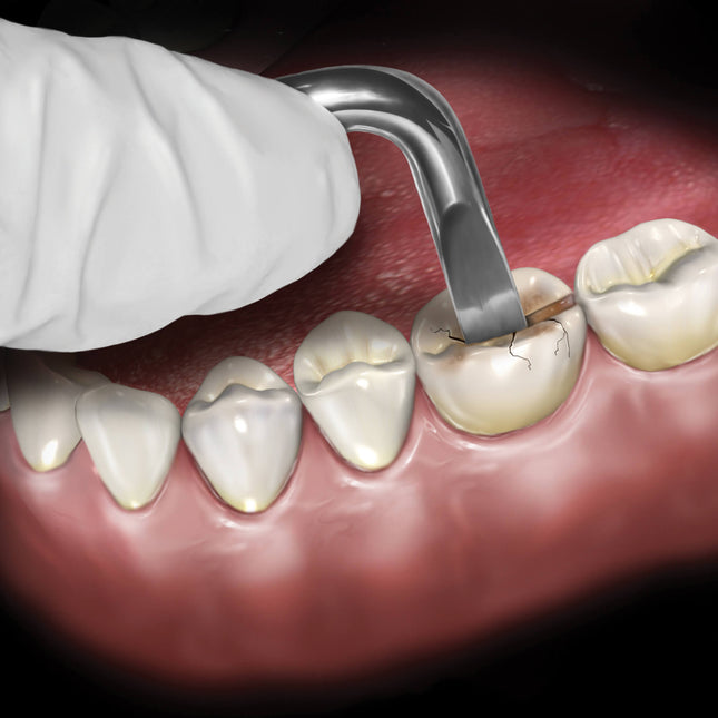 Hu-Friedy Occlusal Surface Goldstein Crown Remover | SurgiMac Dental Supply