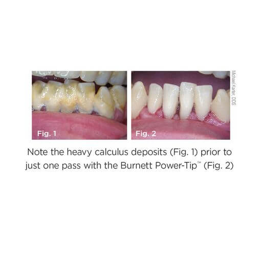 Efficient Deposit Removal: 30K Soft Grip Scaler Tip