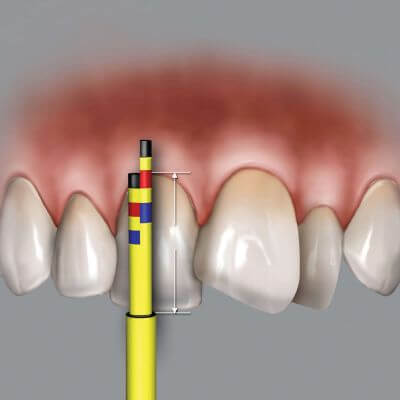 Hu-Friedy Inline Replacement Tips (3 Tips) | SurgiMac Dental Supply