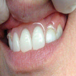 Itsoclear Clasps | SurgiMac Dental Supply