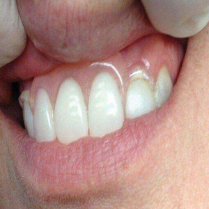 Itsoclear Clasps | SurgiMac Dental Supply