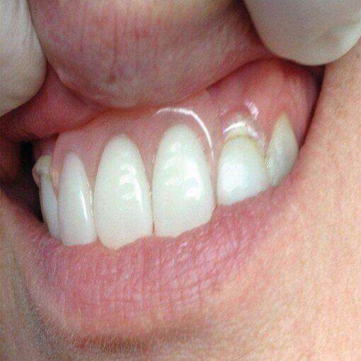 Itsoclear Clasps | SurgiMac Dental Supply