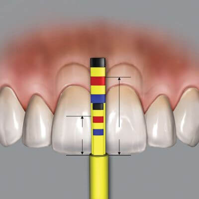 Hu-Friedy Papilla Replacement Tips (3 Tips) | SurgiMac Dental Supply