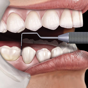 Hu-Friedy CP-11.5B Screening Novatech Color-Coded Probe | SurgiMac Dental Supply