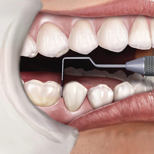 Hu-Friedy CP-11 Novatech Color-Coded Probe | SurgiMac Dental Supply