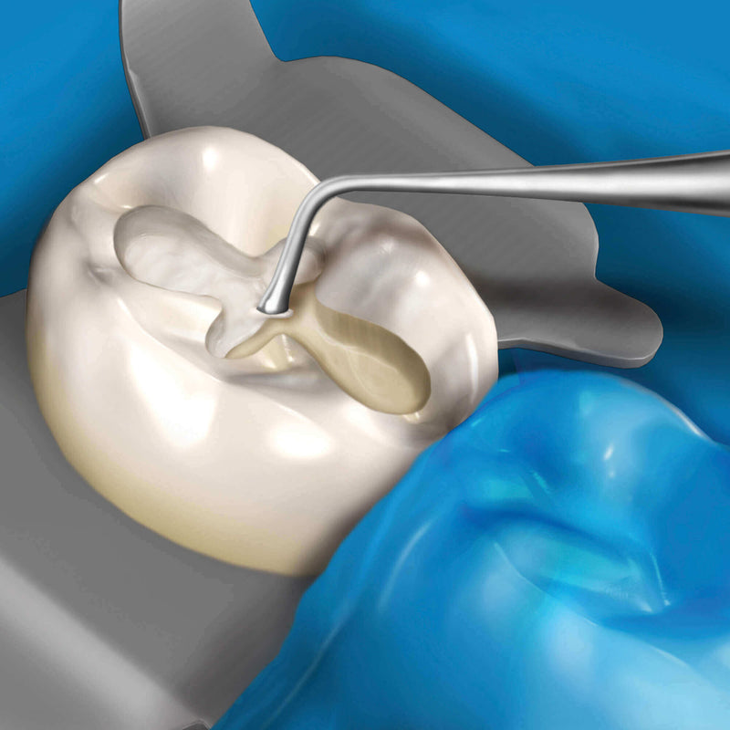 Hu-Friedy 11 Novatech™ Placement Instrument | SurgiMac Dental Supply