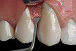 Hu-Friedy PM Nanos A (Angulated), EverEdge™ 2.0, Perio Knife | SurgiMac Dental Supply
