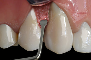 Hu-Friedy PM Nanos A (Angulated), EverEdge™ 2.0, Perio Knife | SurgiMac Dental Supply