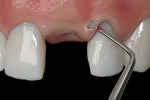 Hu-Friedy PM Nanos A (Angulated), EverEdge™ 2.0, Perio Knife | SurgiMac Dental Supply