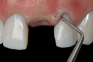 Hu-Friedy PM Nanos A (Angulated), EverEdge™ 2.0, Perio Knife | SurgiMac Dental Supply