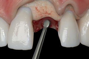 Hu-Friedy PM Nanos S (Straight), EverEdge™ 2.0, Perio Knife | SurgiMac Dental Supply