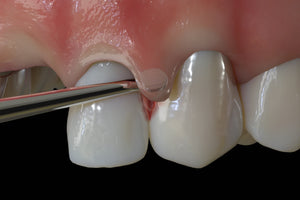 Hu-Friedy PM Nanos S (Straight), EverEdge™ 2.0, Perio Knife | SurgiMac Dental Supply