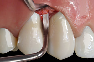 Hu-Friedy PM Prodigy Surgical Curette, Short, EverEdge™ 2.0 | SurgiMac Dental Supply