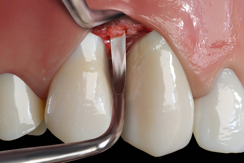 Hu-Friedy PM Prodigy Surgical Curette, Short, EverEdge™ 2.0 | SurgiMac Dental Supply